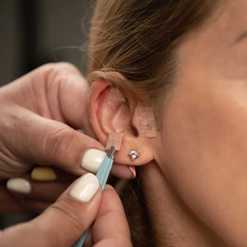 Ear-Acupuncture-2